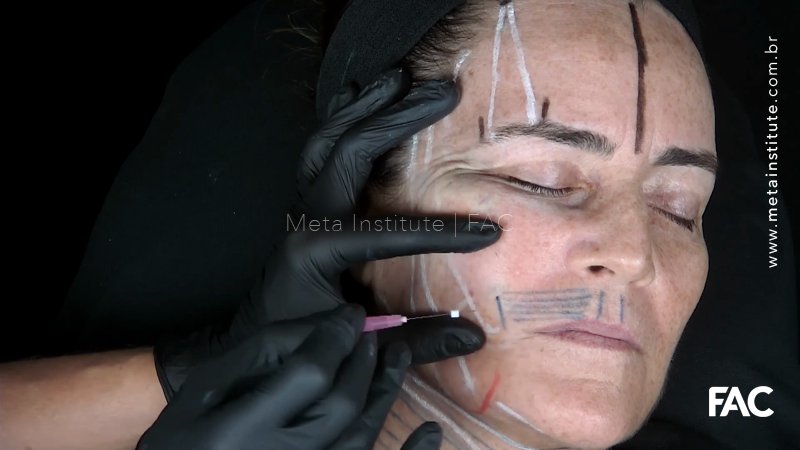 Abordagem facial com fios de PDO (PARTE 1). Marcação full face e aplicação de fios monofilamentares
