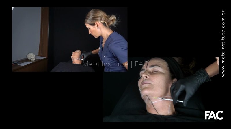 Abordagem facial com fios de PDO (PARTE 2).  Tratamento de pescoço com fios PDO de tração