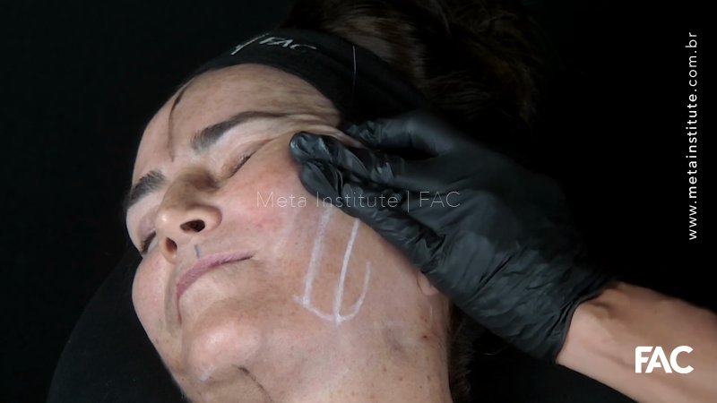 Abordagem facial com fios de PDO (PARTE 3).  Tratamento de face com fios PDO de tração