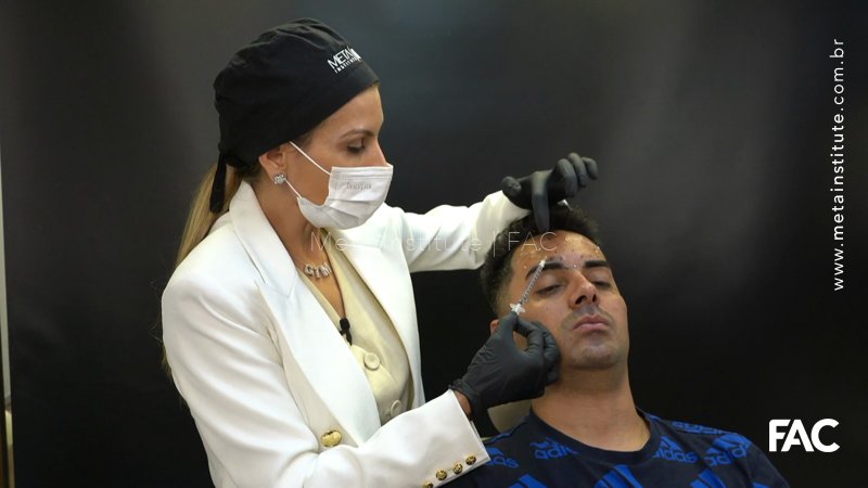 Atualizações Toxina Botulínica face masculina – Especial Lançamento Nabota Chile
