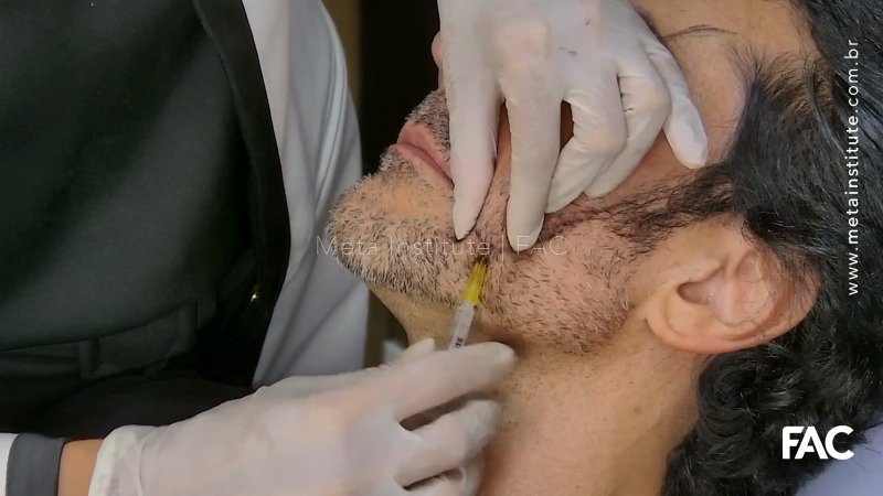 Aula 209 – Bioestimulador de face masculina – cobertura cutânea espessa com PMMA a 10% – Linnea Safe