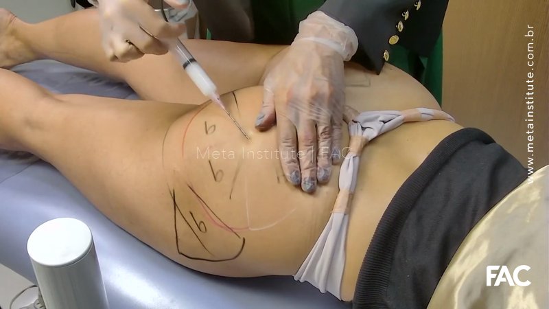 Aula 232 – Bioestímulo de região glútea com Polimetilmetacrilato 10%