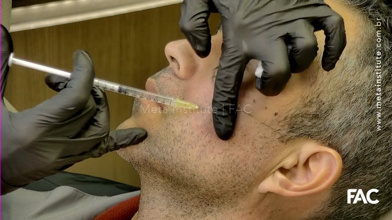 Bioestímulo com Radiesse Duo face masculina
