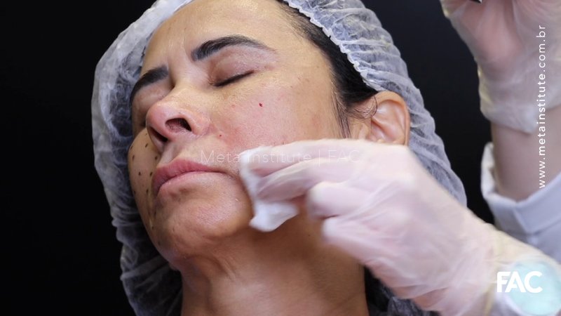 Biorevitalização facial com ácido hialurônico de alto peso molecular sem aditivos
