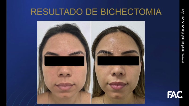 Bônus – Anatomia e Relevância da bola de Bichat para a estética facial – Dr. Douglas Costa