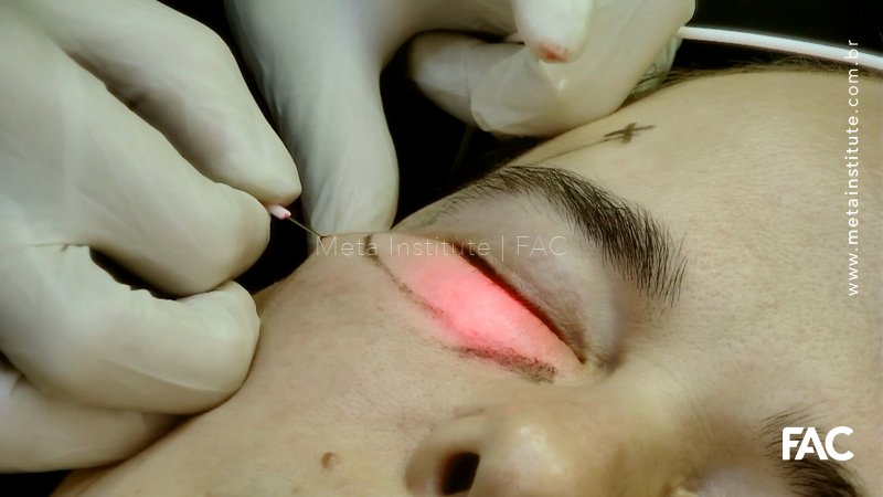 Endolaser região periorbital inferior