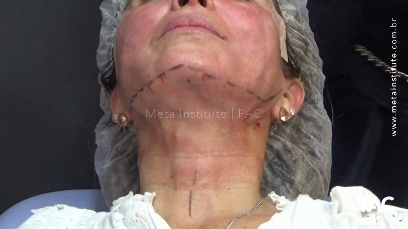Fios cervicais de tração associados a fios de bioestímulo cervical