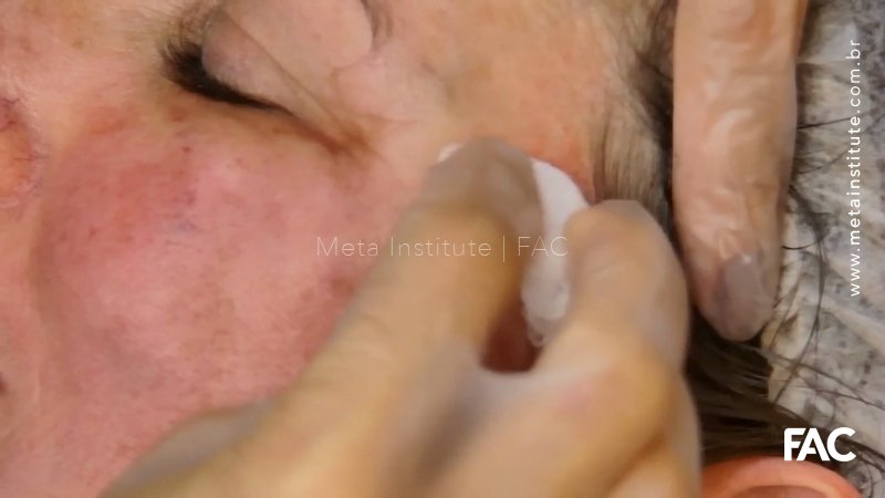 Fios faciais de tração em Jowl e gordura Nasogeniana associados a fios de bioestímulo