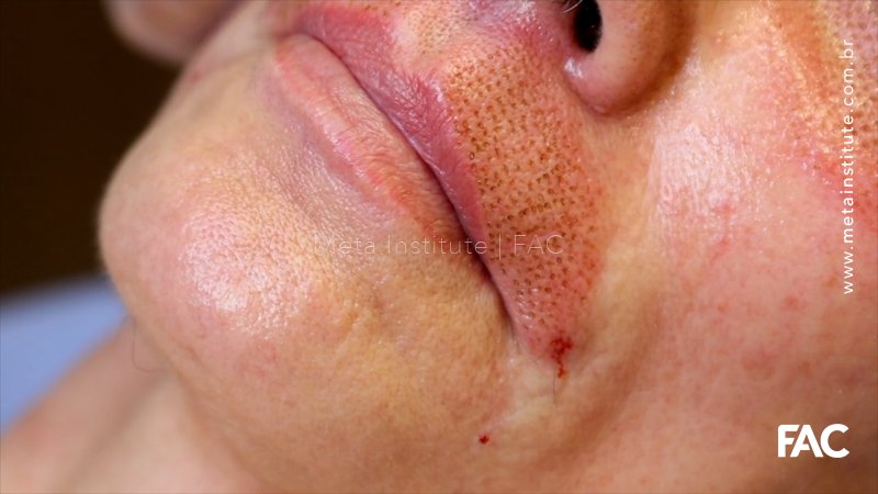 Jato de Plasma para tratamento dos códigos de barras