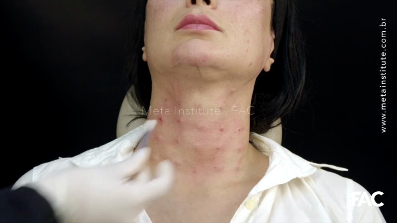 PDRN – Triple Layer Technique: Face, Pescoço, Colo e Mãos