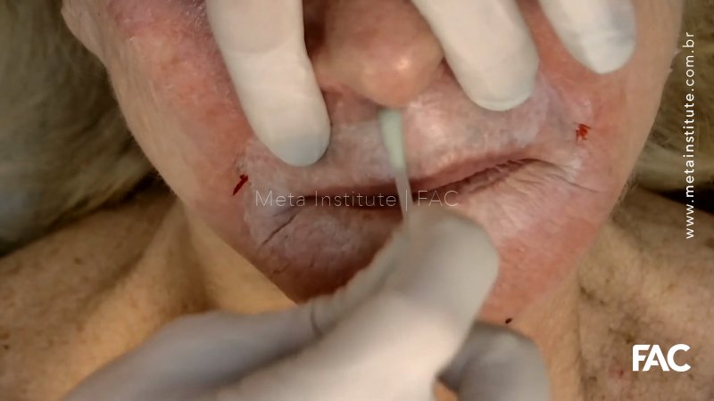 Peeling de Fenol região PERIORAL