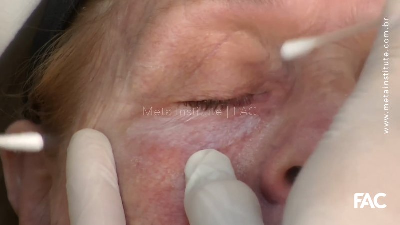 Peeling de Fenol região PERIORBITAL –