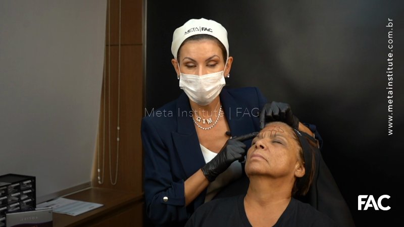 Preenchimento da Região Frontal: Qual o melhor produto para não haver nódulos?