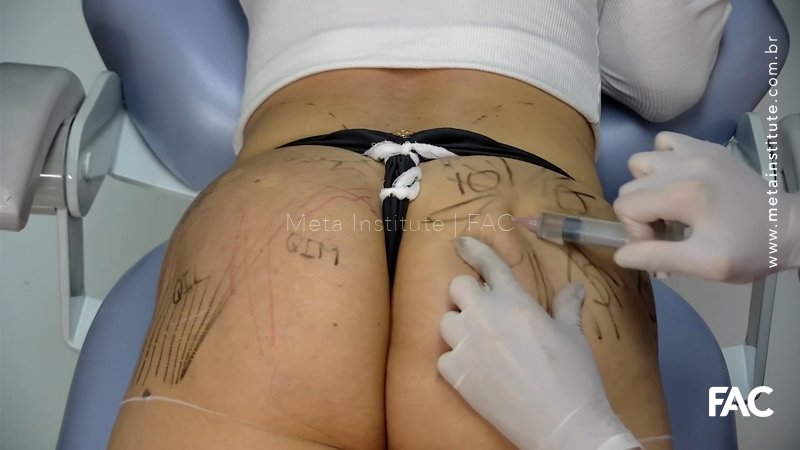 Preenchimento de glúteos com AH – Especial Body Academy