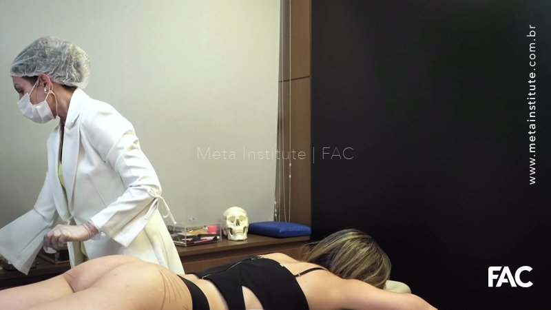 Preenchimento de Glúteos com AH Sofiderm – Derm Subskin