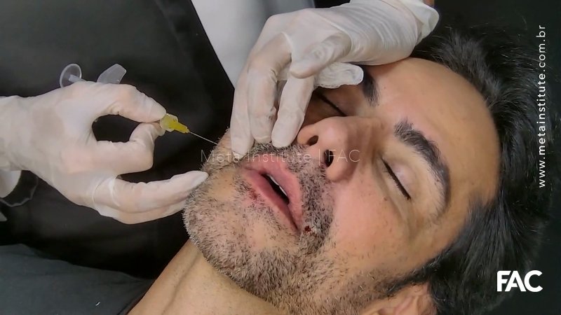 Preenchimento de lábios masculinos finos com Rennova Lift