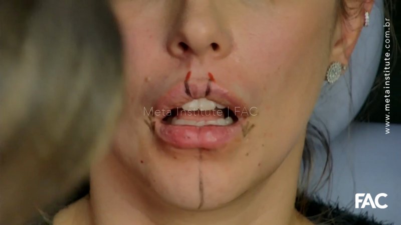 Preenchimento labial  para detalhamento – Signature Technique Patrícia Leite