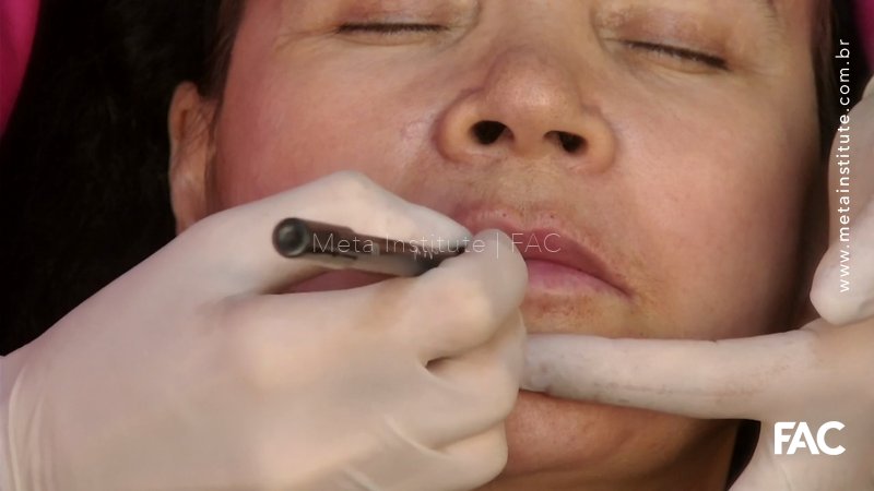Preenchimento Labial: técnica mista com cânula e agulha