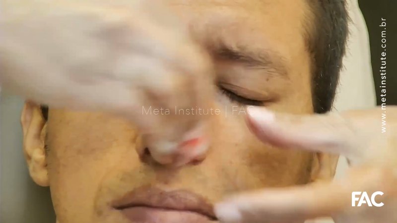 Preenchimento nasal masculino-ênfase em dorso e assimetrias