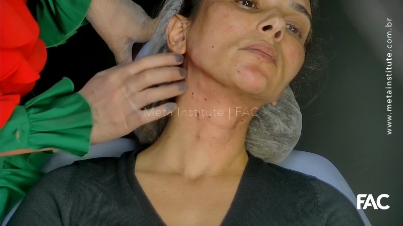 Profhilo Cervical