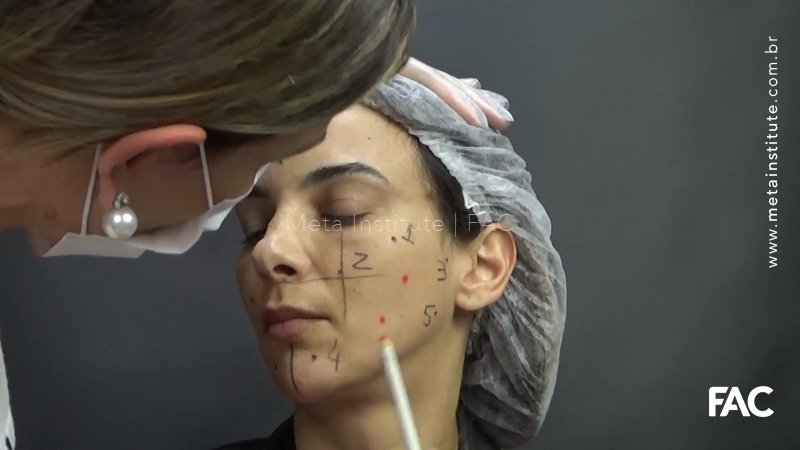 Profhilo facial – posicionamento após quase um ano de mercado brasileiro e proposta de nova técnica para a face