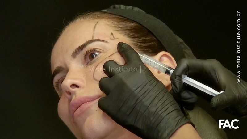 Protocolo híbrido de tratamento facial: BIODUO – bioestímulo e preenchimento ao mesmo tempo