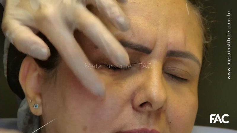 Técnica Coreana: Fio PDO mono embebido em Toxina Botulínica