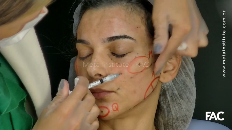 Técnica de Oval CAM para embelezamento facial