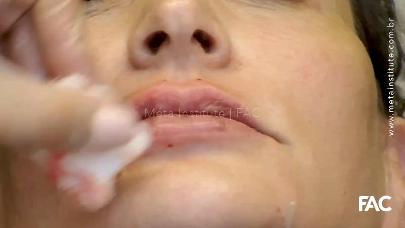 Touch Up Lips – Refinamento de lábios