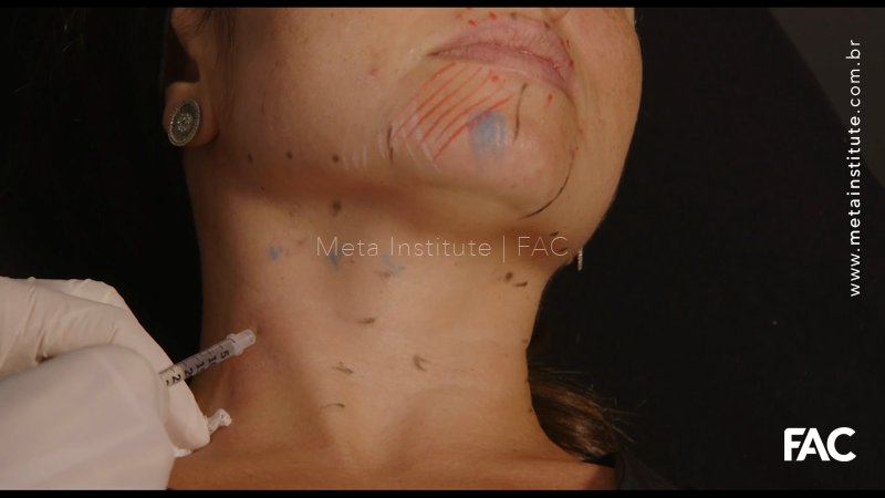 Toxina Botulínica Full Face