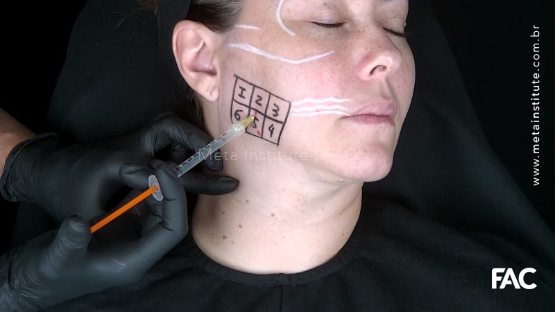 Tratamento da hipertrofia de Masseter e Temporal com toxina botulínica