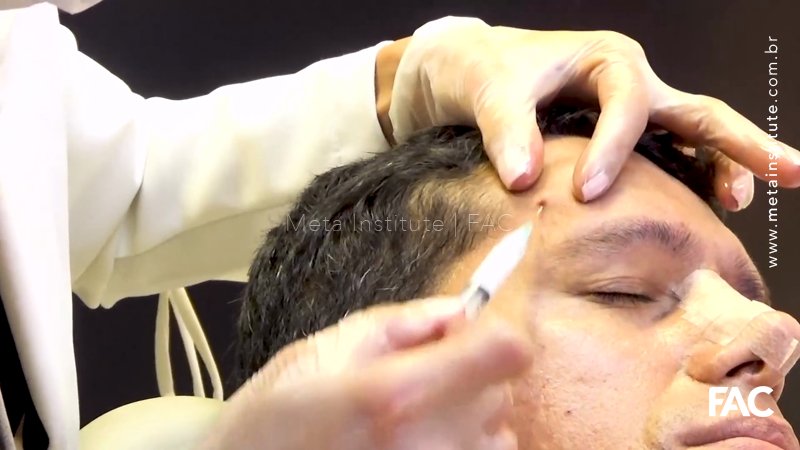 Tratamento da Região Frontal com Bioestimulador Diluído