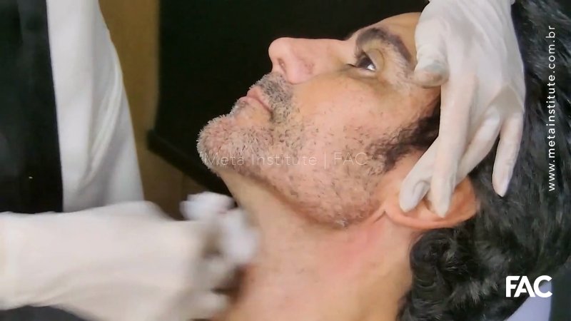 Tratamento de terço inferior de face masculina com Yvoire Contour – Queixo e mandíbula